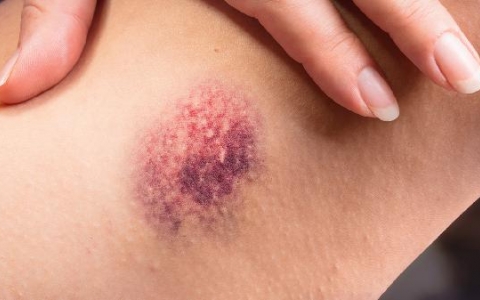 有伤口能坐飞机吗