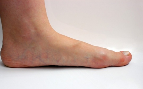 脚气烂脚趾缝痒溃烂怎么引起的