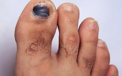 指甲夹伤脱落的指甲怎么办