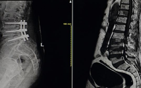 强直脊柱炎一般怎么疗疹