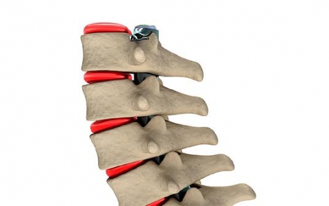 强直脊柱炎可以如何防患