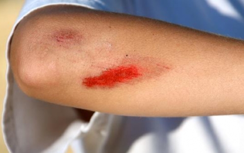 肺脓肿用什么抗生素