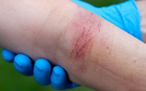 肺脓肿打消炎针得好吗