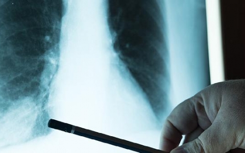 肺大泡是抽烟引起的吗