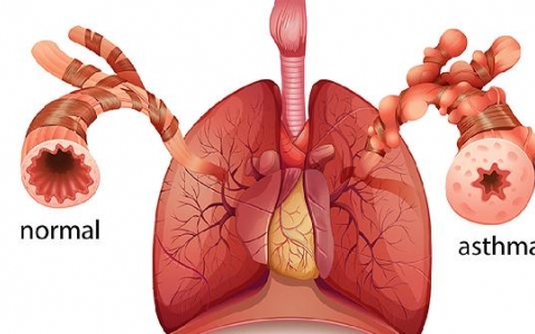 肺脓肿怎么引起的