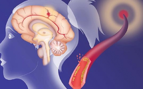 颅内出血和脑梗死半面身体没有感觉