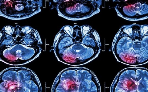 脑梗死后如何消肿