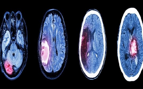 如何治疗颅脑损伤