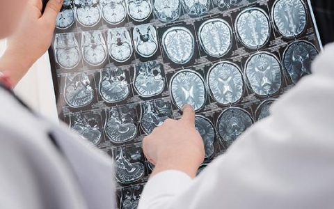 脑梗死的症状是什么？