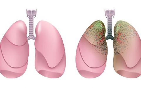 肺结节laruds二类