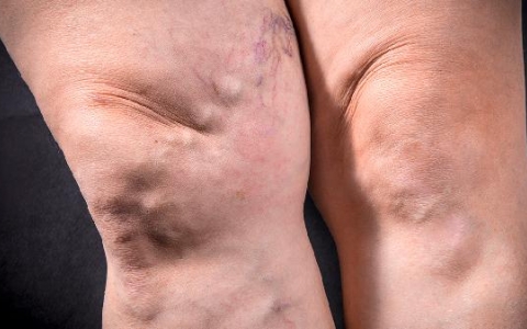 揭秘凹陷性水肿：8大潜在健康隐患，你中招了吗？