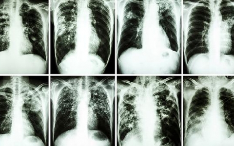 肺结节挨着动脉会怎么样