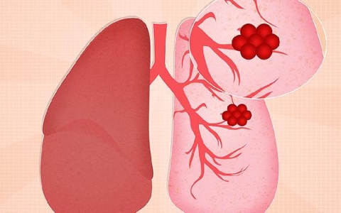 肺部结节能看出是良性还是恶性