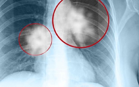 肺结节拔管回家怎么护理