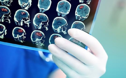 左侧基底节区脑梗：识别症状、及时就医，重拾健康生活的关键