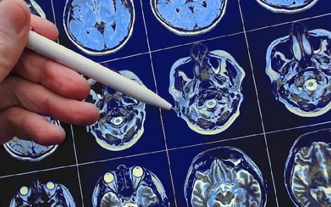 脑衰竭的症状有哪些？