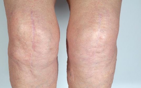 右脚浮肿好几年了不疼不痒