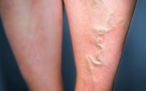 手指轻度浮肿是怎么回事