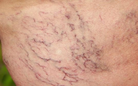 盐分摄入过多水肿怎么办