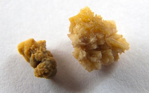 尿酸值降至正常多久能溶石