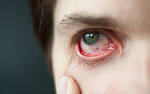 强直性脊柱炎患者如何识别眼部问题？虹膜炎、干眼症还是角膜炎？