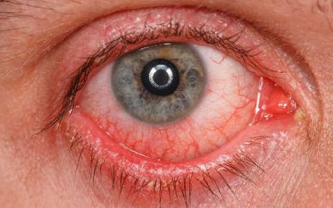 强直性脊柱炎患者如何有效管理虹膜炎？教你三大妙招！