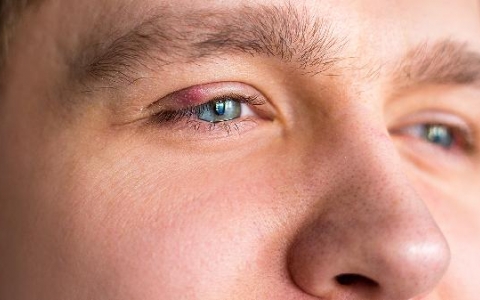 眼睛老是流眼泪特别是风吹更厉害