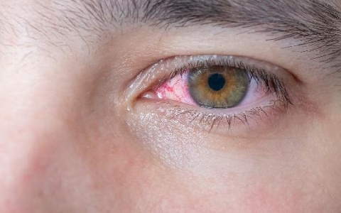 眼睑痉挛怎么缓解症状