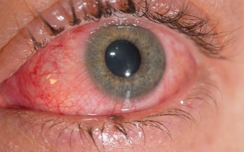 之前带了三年的美瞳眼睛一点儿事没有