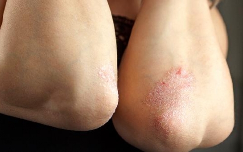 全身性皮肤病包括那些症状