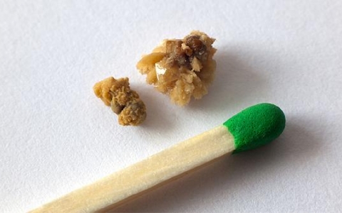 肾盂输尿管移行处结石可碎石吗