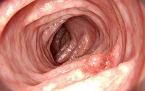 鼻窦、鼻腔囊肿破出血