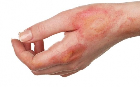 儿童烧伤恢复快吗