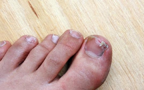 孩子手指甲脱层怎么回事