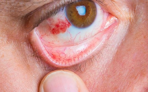 做眼睑外翻矫正副作用有哪些