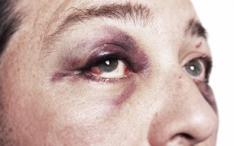 眼睑内翻矫正手术注意事项是什么？