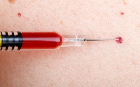 屁股长脓包挤出血