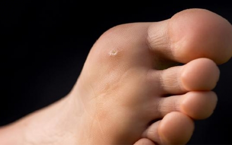 扁平足18岁后还能矫正吗