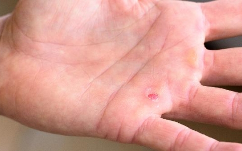 并指畸形怎样矫正快一点呢