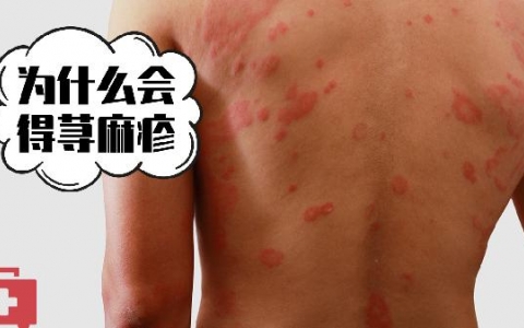 荨麻疹是怎么引起的及治疗方法及注意事项