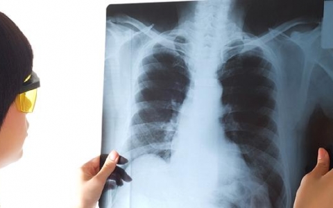 肺气肿可以抽烟喝酒吃辣吗