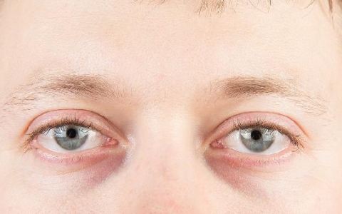 黑眼圈太重了太黑了怎么去掉青少年