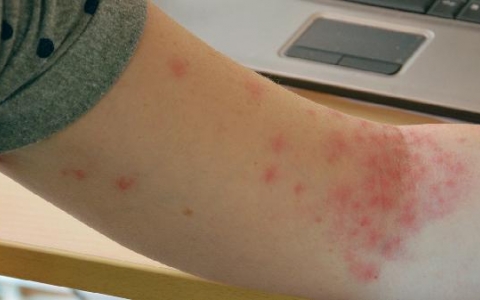 HPV检查报告怎么看出来有问题