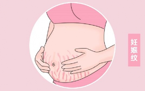 产后去除妊娠纹用什么方法
