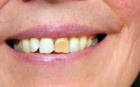 老年人种植牙好不好的原因是