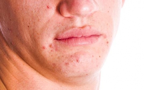 过敏性紫癜忌口的食物有哪些呢