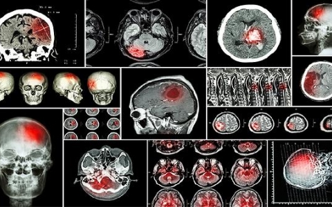 肿瘤坏死因子a高说明什么身上的结节可怕吗