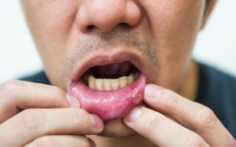 男子患牙周炎又常熬夜牙齿全掉光
