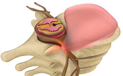 左侧屁股疼坐骨神经痛怎么治疗