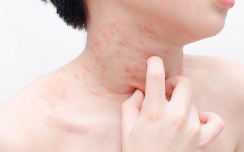 疱疹性咽颊炎的症状及治疗?